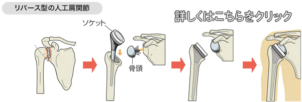 新技術のリバース型人工肩関節置換術 | あかばね整形外科